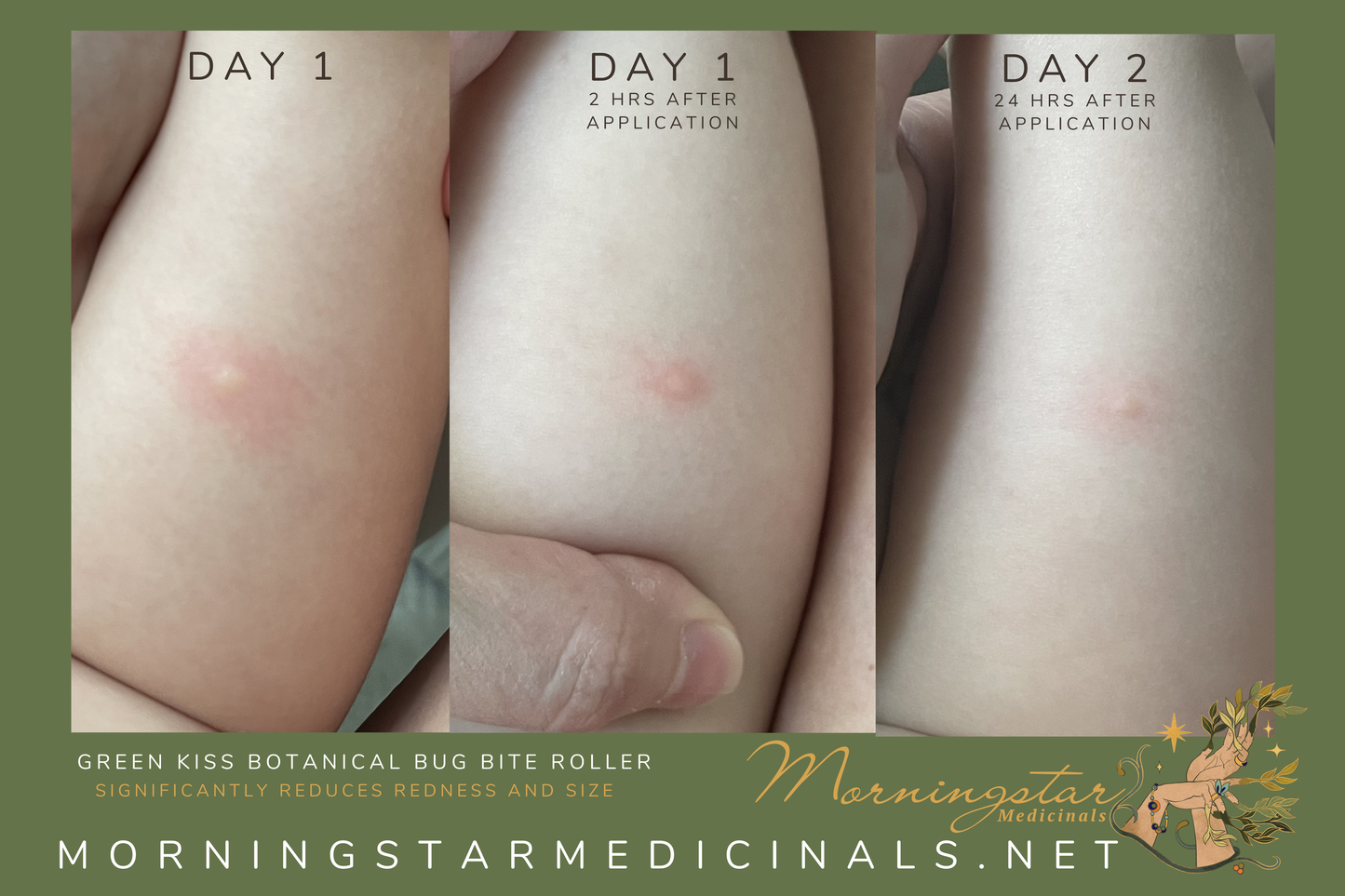 Green Kiss: Bug Bite Roller